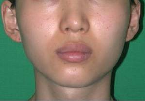 A widened lower jaw can be caused by a enlarged masseter muscle. Botox can reduce the width of the jaw by making the muscle smaller.