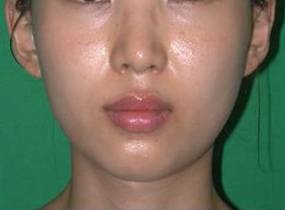 Botox treatment for narrowing the lower jaw improves facial contour.